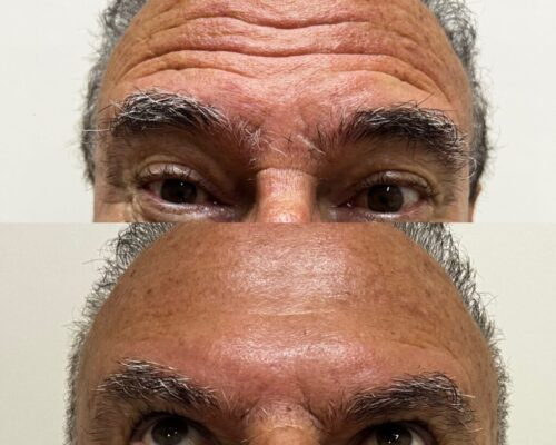 Antes e depois do botox 1