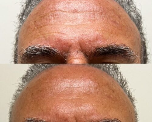 Antes e depois do botox