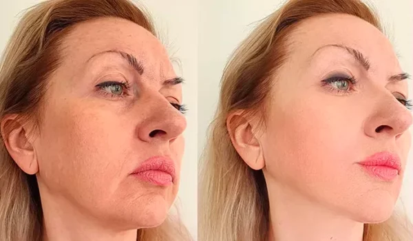 facial facial
