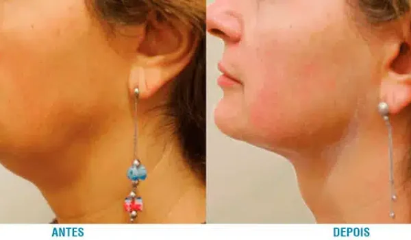 papada-ultraformer3-antes-e-depois.jpg papada-ultraformer3-antes-e-depois.jpg